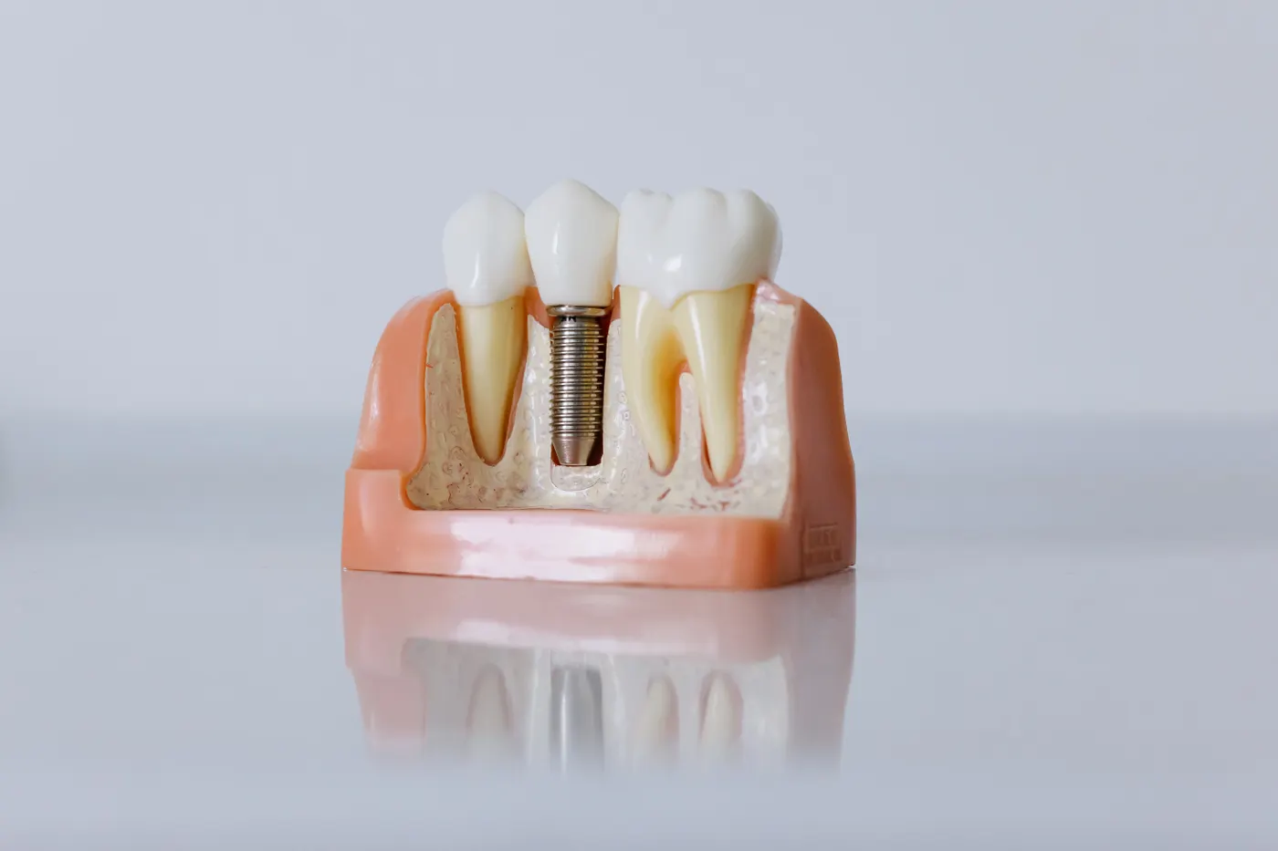 A model showing a dental implant between natural teeth